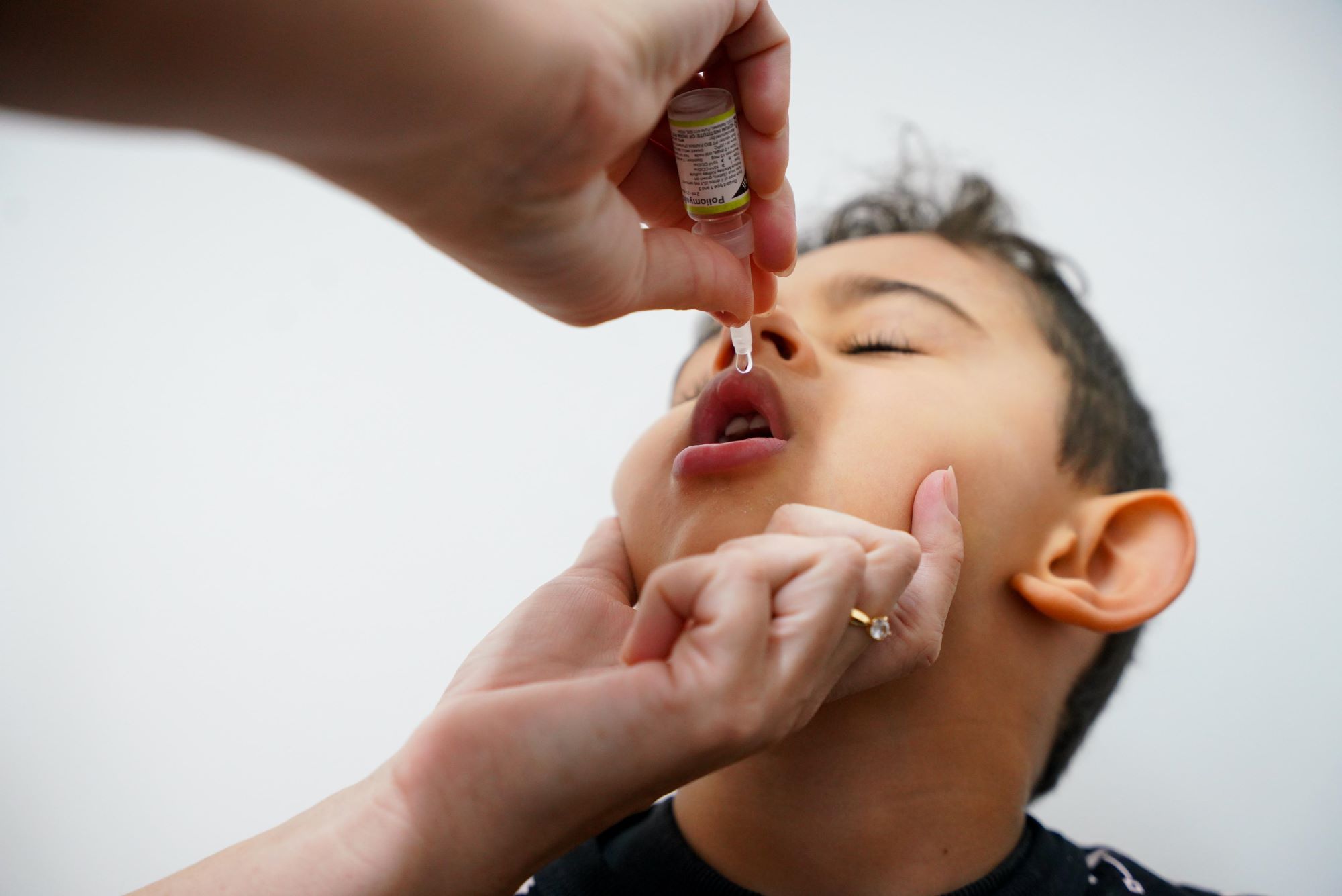 Criança de olhos fechados recebe dose de vacina oral contra poliomielite, com o rosto inclinado para trás enquanto uma profissional aplica cuidadosamente as gotinhas.