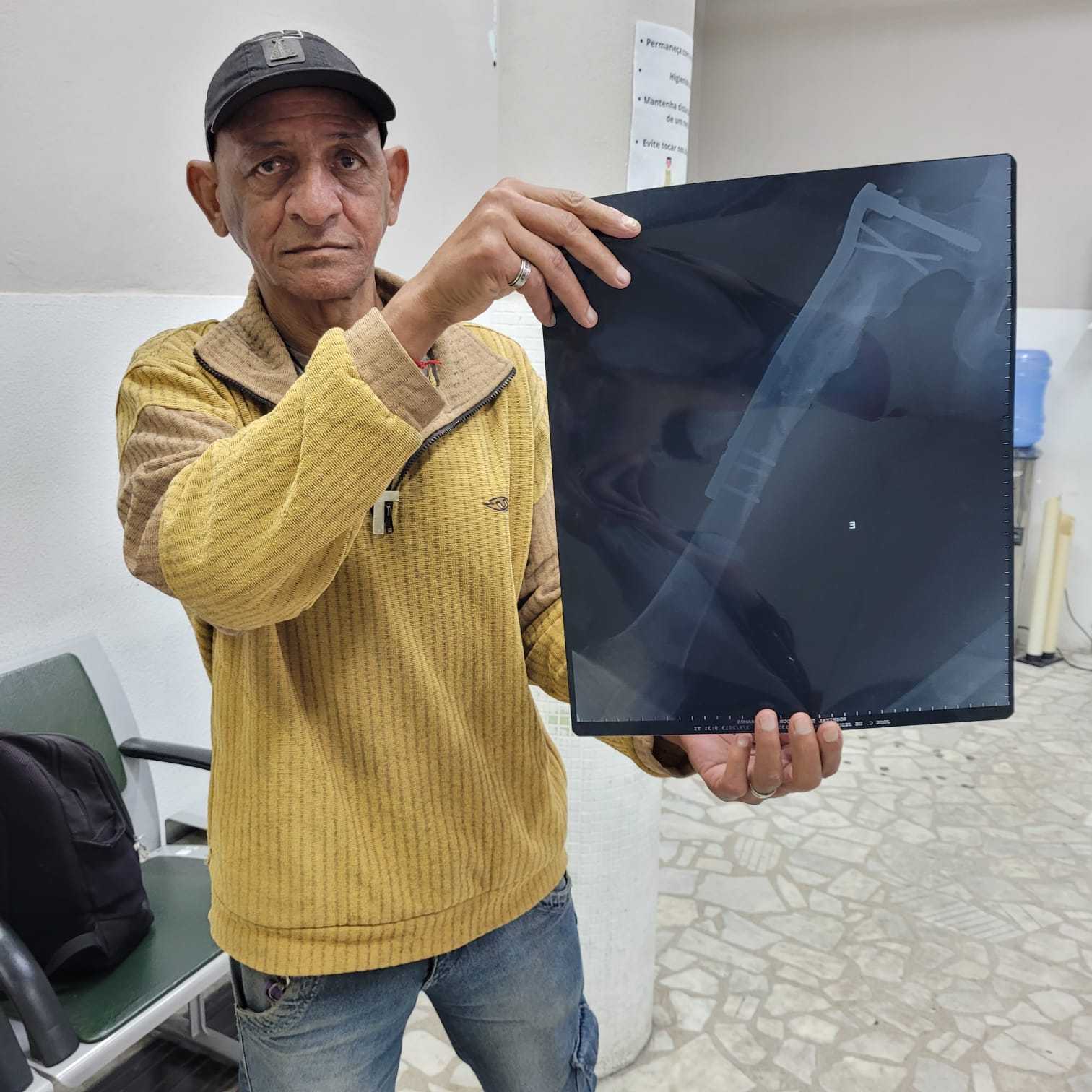 Homem com expressão séria segura uma radiografia que mostra uma perna com fixação ortopédica por parafusos e placa metálica. Ele está em um ambiente hospitalar, vestindo blusa de lã amarela, boné preto e jeans, próximo a cadeiras de espera e cartazes na parede.