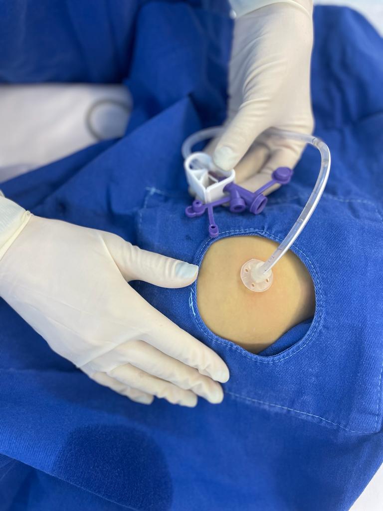 Mãos com luvas cirúrgicas manipulando uma sonda de gastrostomia inserida no abdômen de um paciente. A área ao redor está coberta com campo cirúrgico azul, com uma abertura que expõe o local da inserção da sonda.