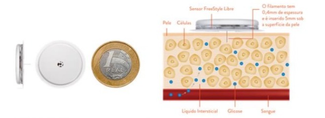 Imagem mostra o sensor de glicose FreeStyle Libre ao lado de uma moeda de 1 real para comparação de tamanho. Ao lado direito, uma ilustração em corte transversal da pele mostra como o sensor é inserido cerca de 5 mm sob a superfície, alcançando o líquido intersticial onde mede os níveis de glicose. O sensor possui um filamento de 0,4 mm de espessura.