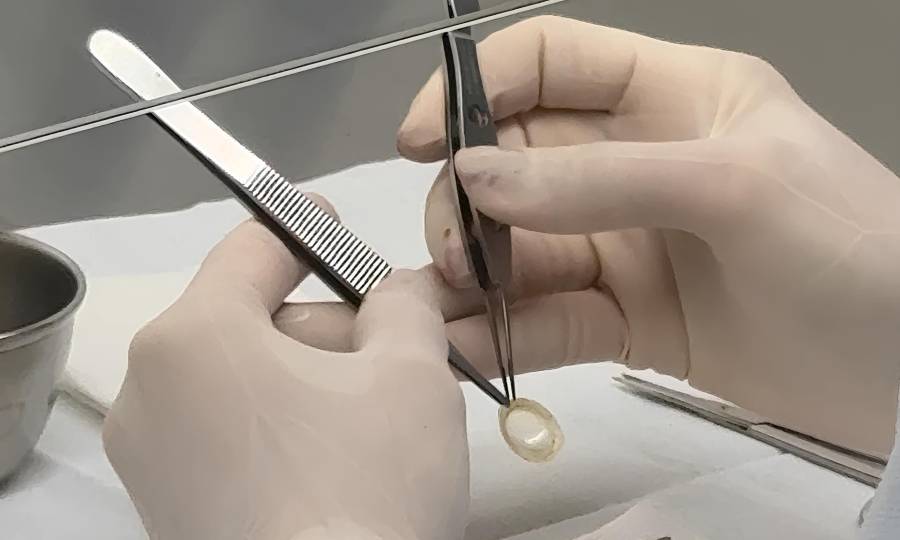 Banco de Olhos garante qualidade dos tecidos oculares doados em Santa Catarina