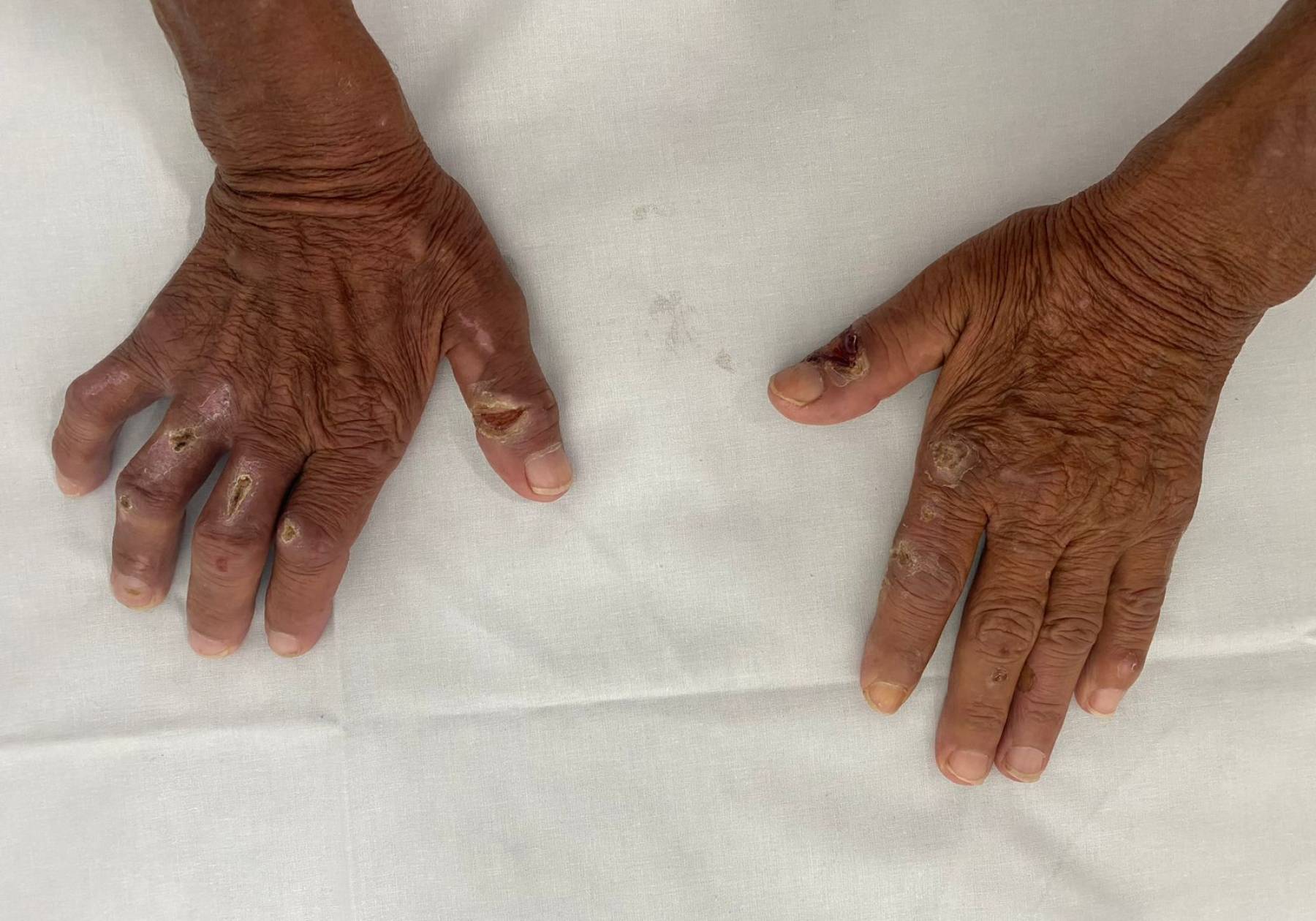 Dia de Combate e Prevenção à Hanseníase reforça importância do diagnóstico precoce e do enfrentamento ao estigma