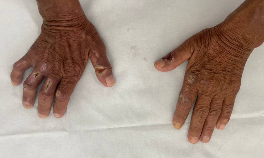 Dia de Combate e Prevenção à Hanseníase reforça importância do diagnóstico precoce e do enfrentamento ao estigma