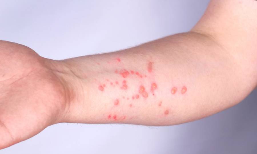 Santa Catarina segue sem casos de Mpox e Saúde Estadual reforça orientações